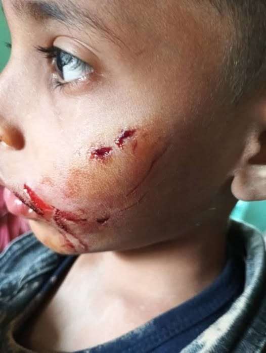 في حادثة مأساوية.. كلب يعض طفلًا صغيرًا في وجهه