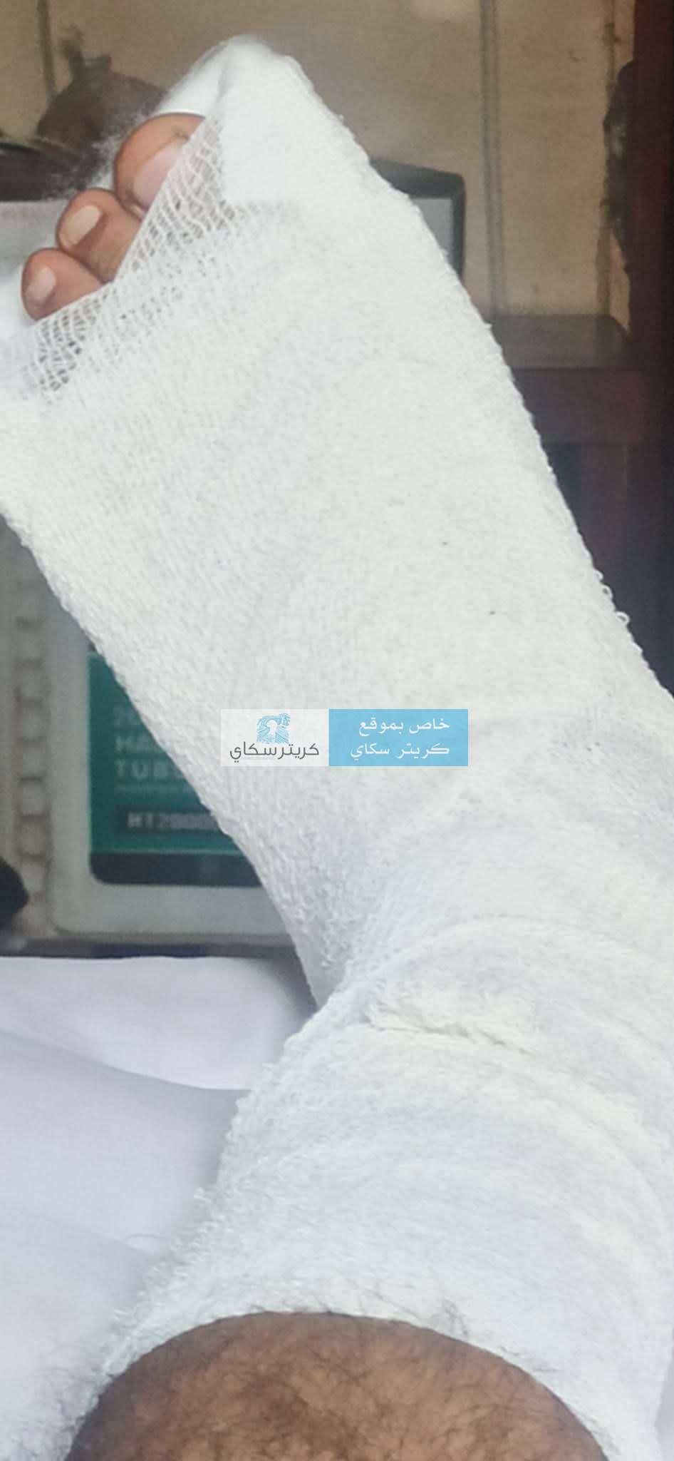 كلاب ضالة تقتحم منزلاً وتتسبب بكسر مواطن في عدن ومناشدة عاجلة للمحافظ