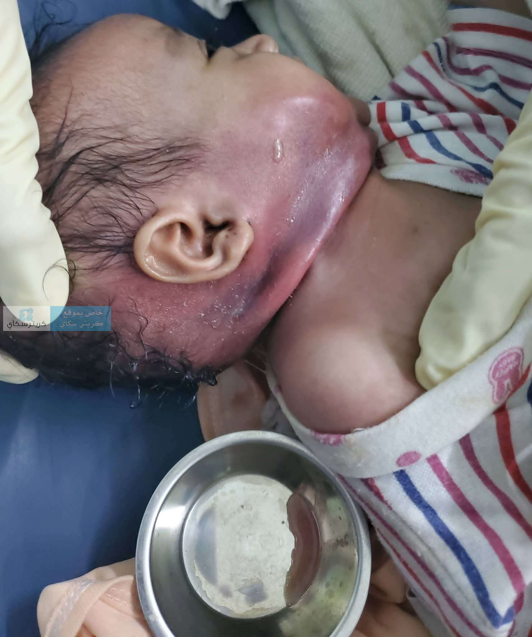 قصة مؤثرة.. تدخل طبي ينقذ رضيعة كانت مهددة بفقدان حياتها