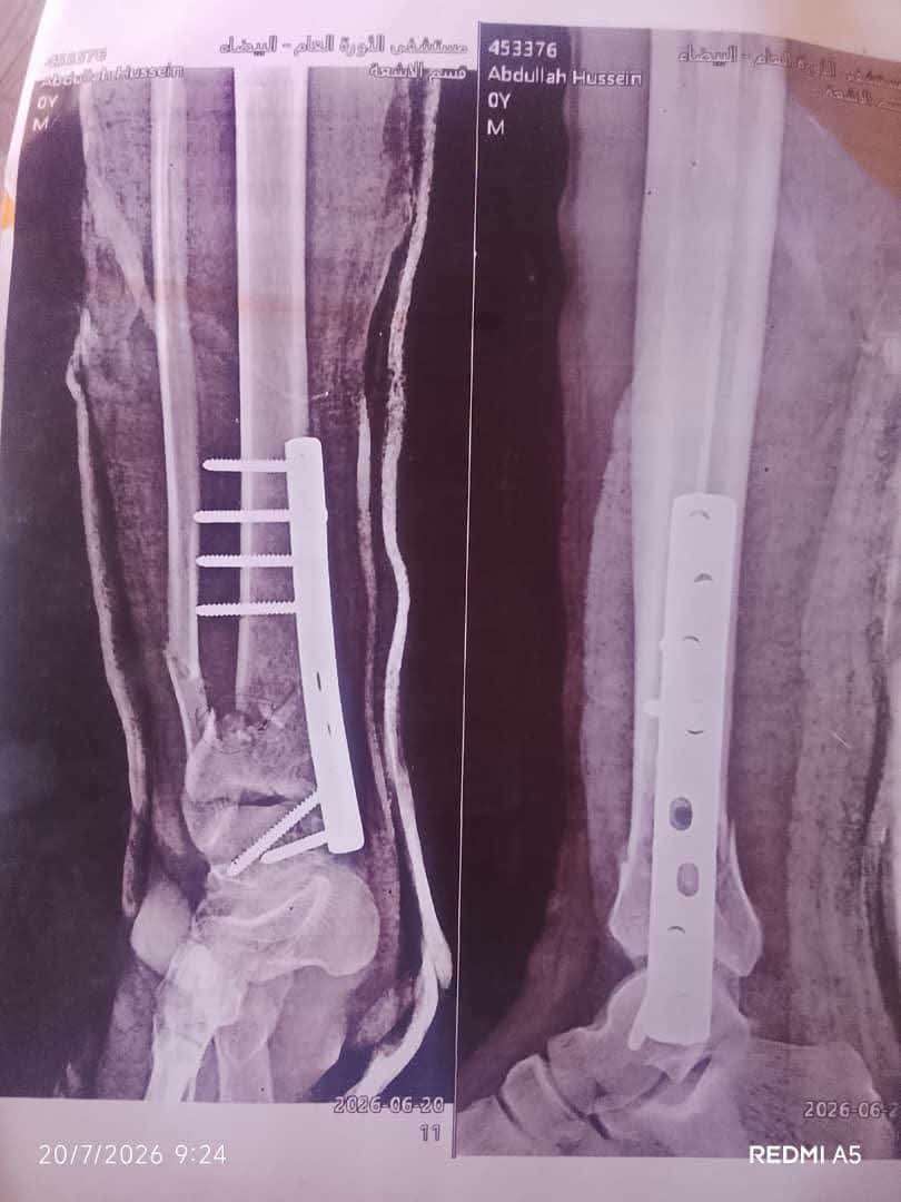 بعد عملية عظام مثيرة للجدل.. دعوات لمحاسبة المسؤولين في المستشفى