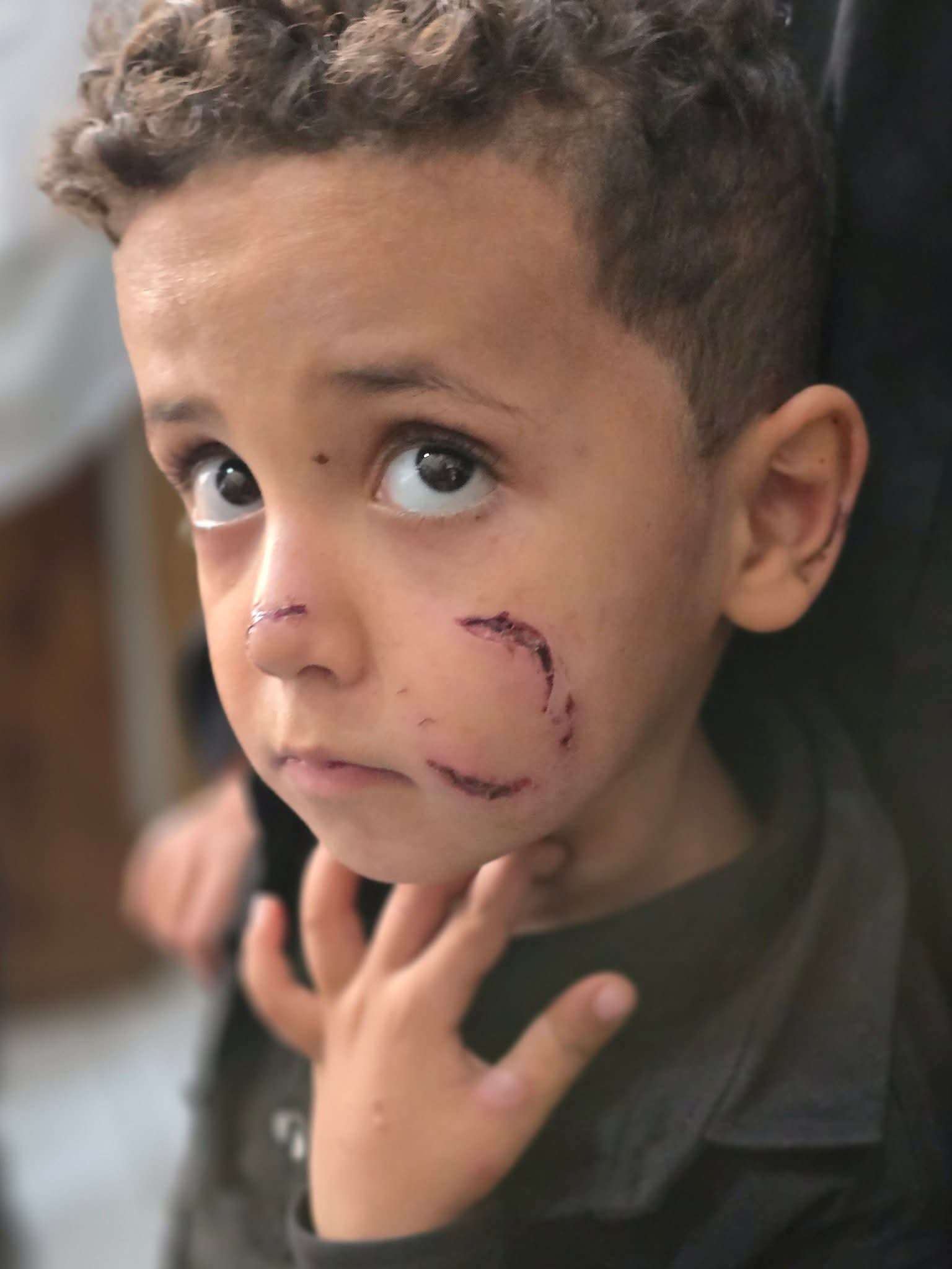 نداء استغاثة في تعز .. اطفال يموتون بسبب نقص اللقاحات