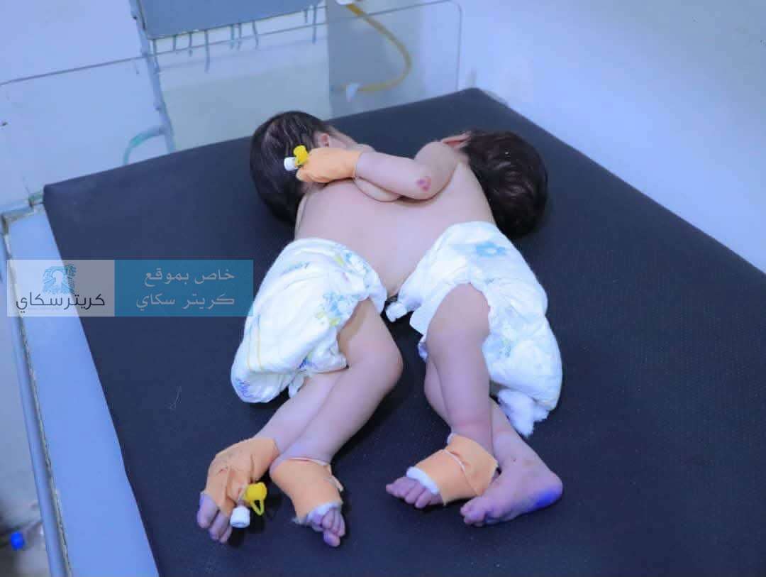 سباق مع الوقت لإنقاذ توأم سيامي حديث الولادة