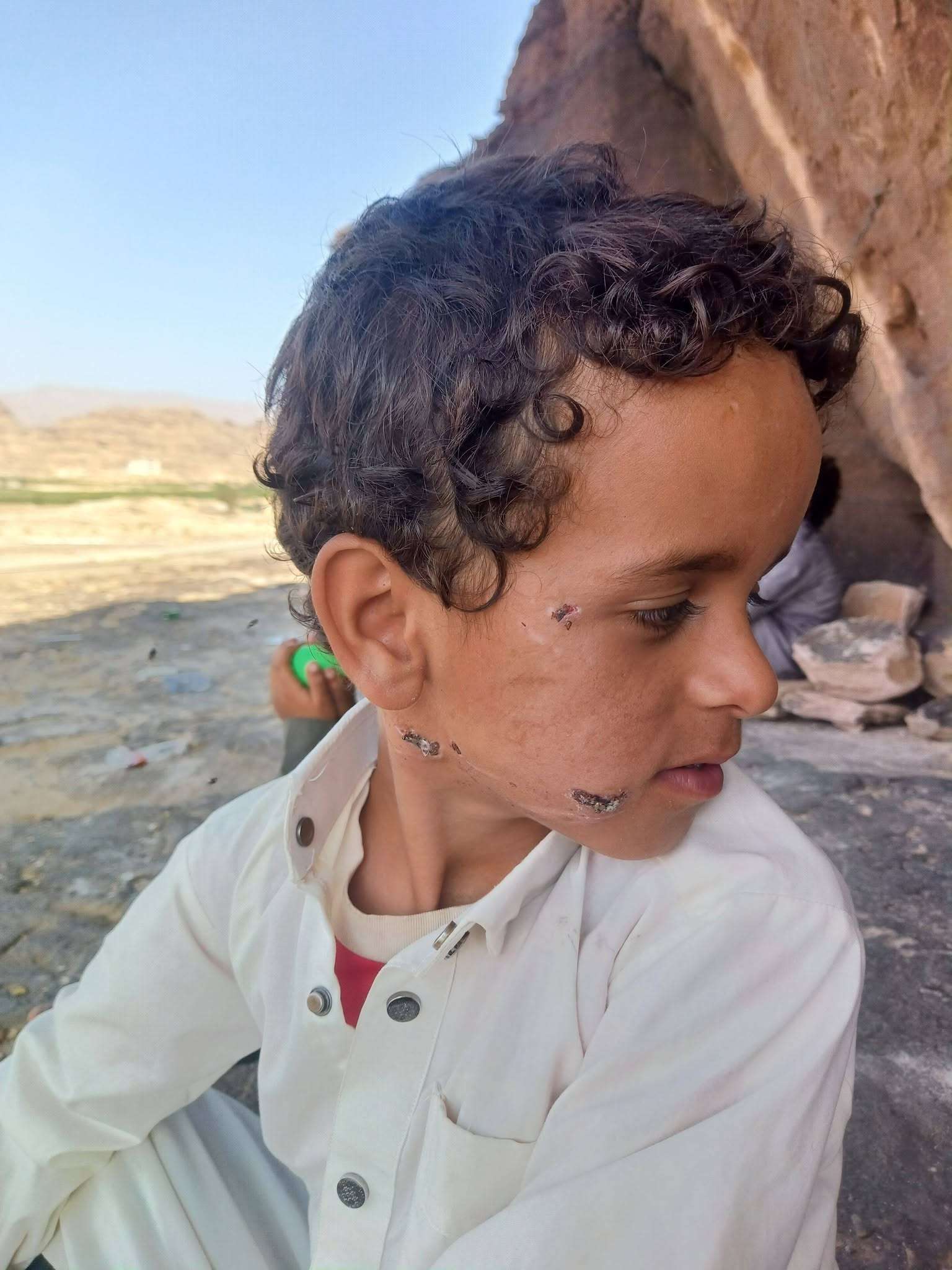 بعد عضة كلب.. طفل في صعدة يتلقى اللقاحات ثم تظهر عليه أعراض داء الكلب بعد 21 يومًا