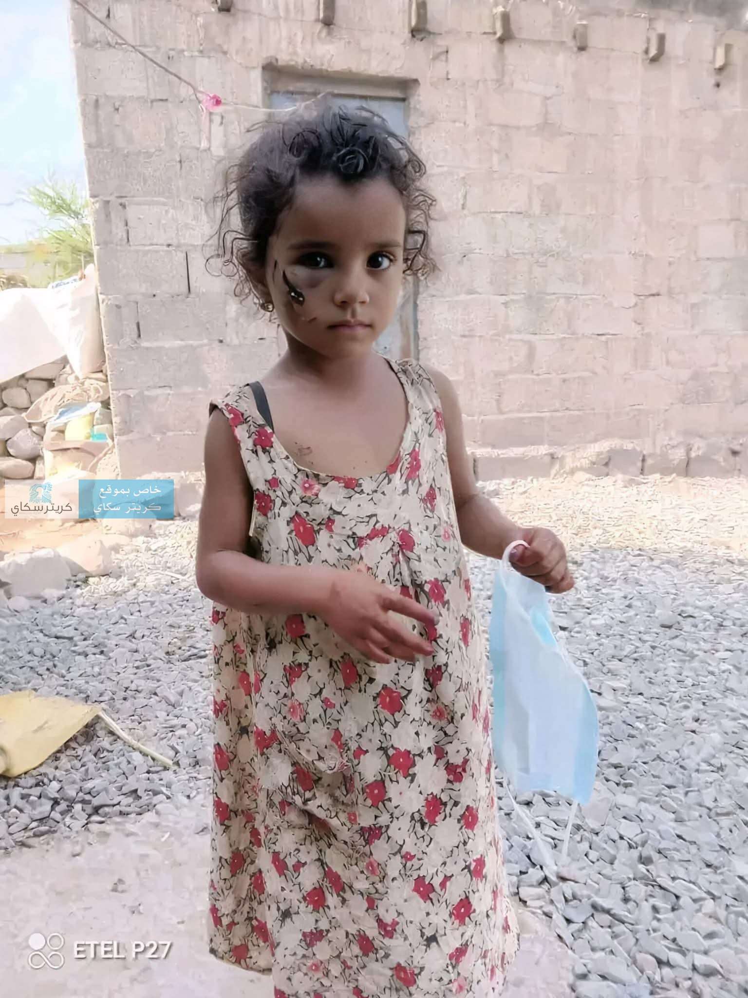 وفاة طفلة بعد أسبوعين من تعرضها لعضة كلب مسعور